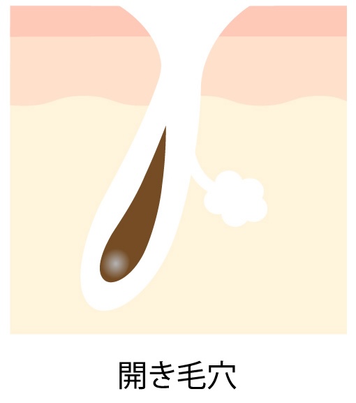 開き毛穴