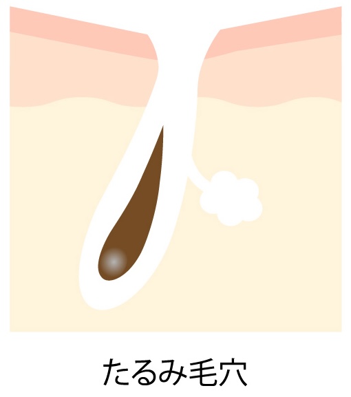 たるみ毛穴